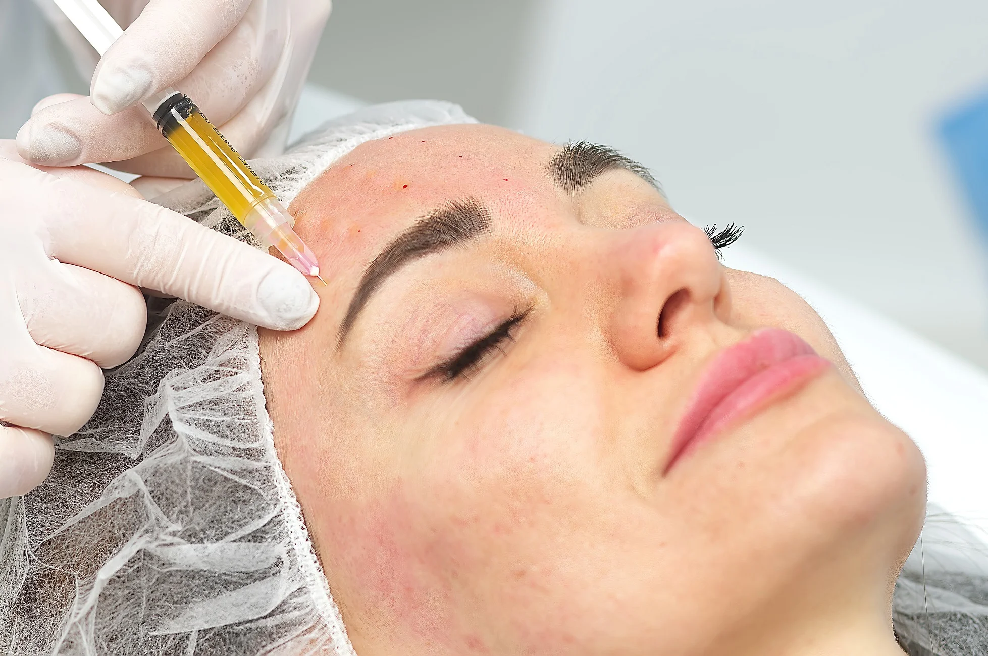 PRP Treatments at Infinite Beauty Lounge